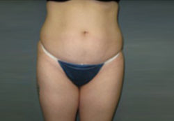 Liposuction