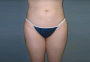 Liposuction