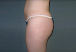 Liposuction