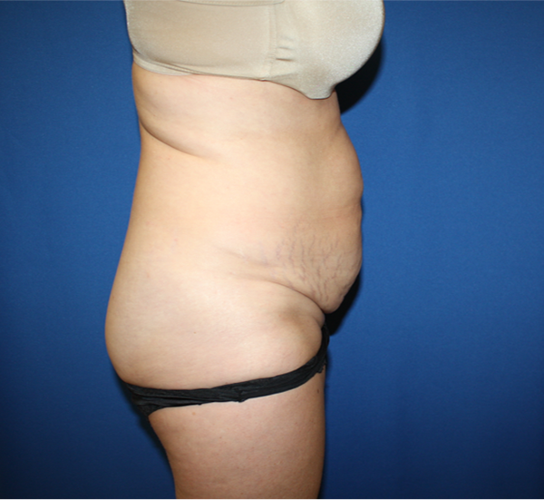 Liposuction