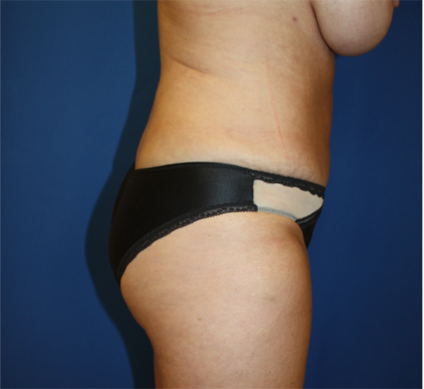 Liposuction