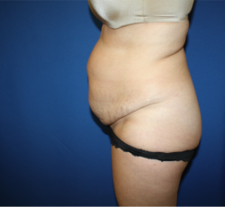 Liposuction