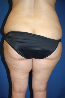 Liposuction