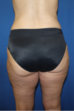 Liposuction