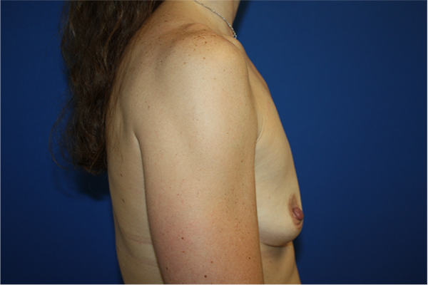 Breast Augmentation