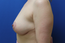 Breast Lift with Fat Graft