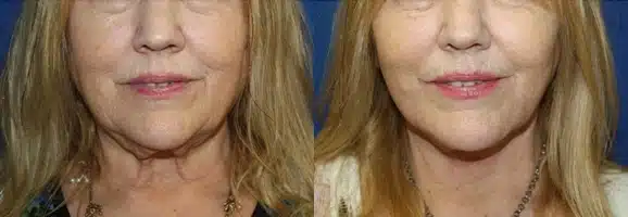 Neck Lift before and after photo by Aesthetic Plastic Surgery North Shore in Beverly, MA