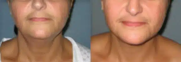 Neck Lift before and after photo by Aesthetic Plastic Surgery North Shore in Beverly, MA