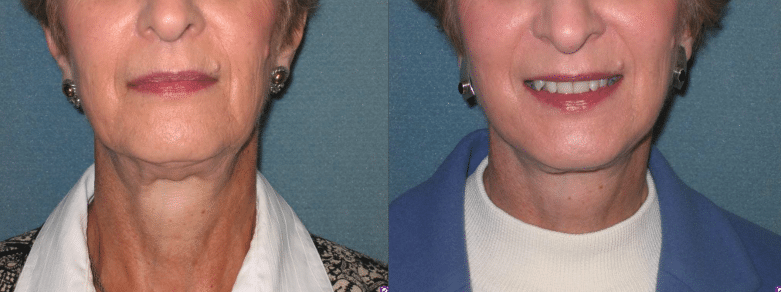 facelift before and after photo by aesthetic plastic surgery north shore in beverly ma