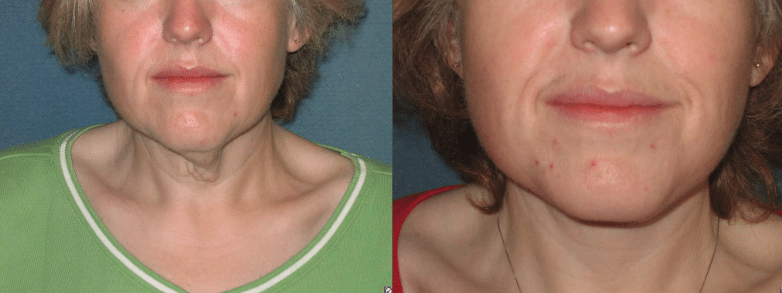 facelift before and after photo by aesthetic plastic surgery north shore in beverly ma